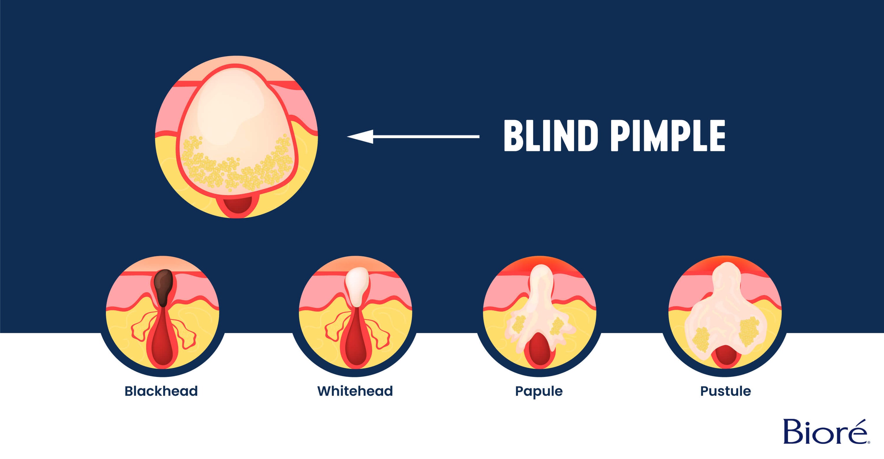 What Is a Blind Pimple?