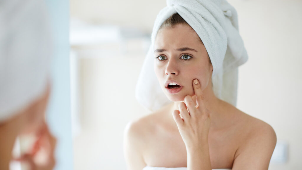 Blackheads on Cheeks: How to Get Rid of Them